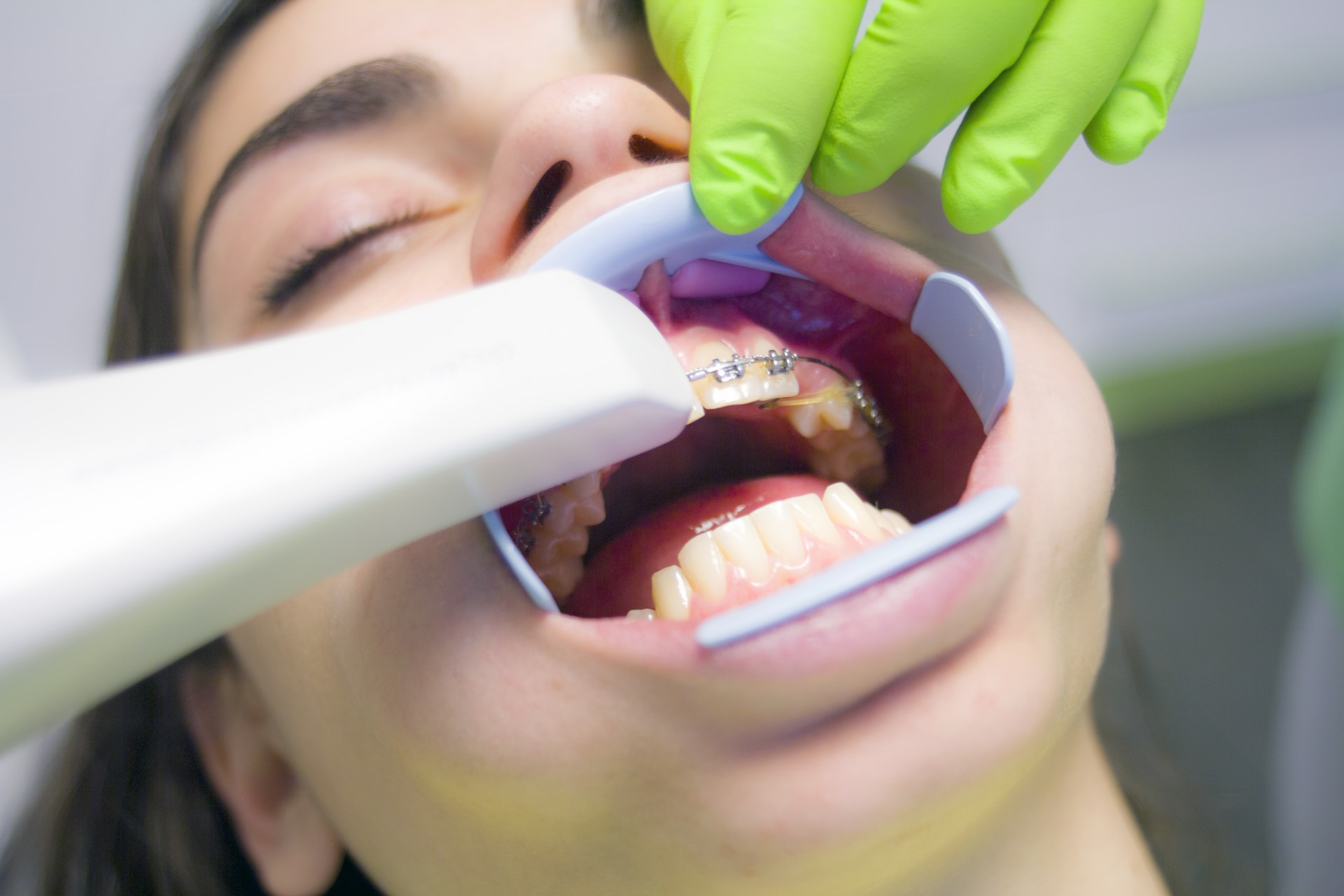Braces and oral hygiene features
